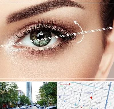 جراحی چشم گربه ای در امامت مشهد