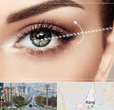 جراحی چشم گربه ای در گوهردشت کرج 