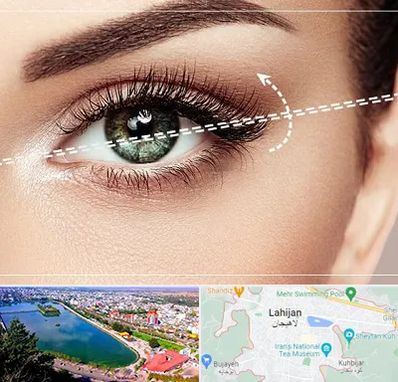 جراحی چشم گربه ای در لاهیجان