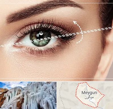 جراحی چشم گربه ای در میگون