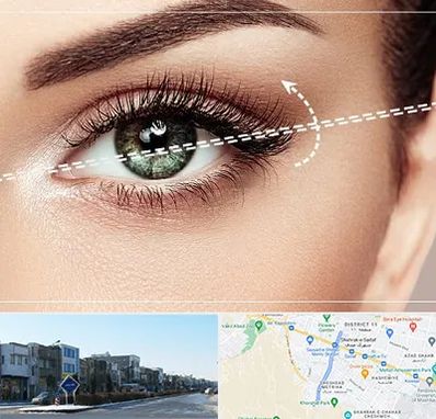 جراحی چشم گربه ای در شریعتی مشهد