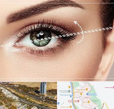 جراحی چشم گربه ای در خیابان نیایش شیراز