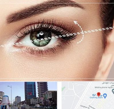 جراحی چشم گربه ای در چهارراه طالقانی کرج