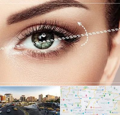 جراحی چشم گربه ای در منطقه 7 تهران 