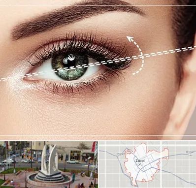 جراحی چشم گربه ای در زابل