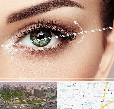 جراحی چشم گربه ای در آیت الله کاشانی