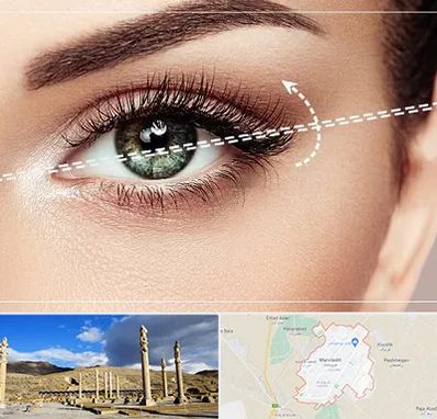 جراحی چشم گربه ای در مرودشت