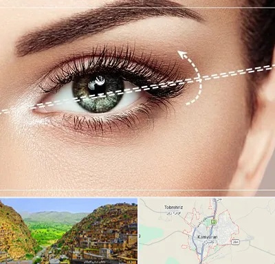 جراحی چشم گربه ای در کامیاران