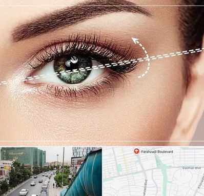 جراحی چشم گربه ای در بلوار فرحزادی