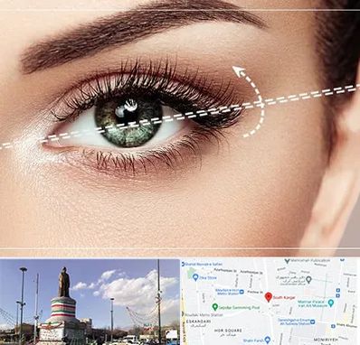 جراحی چشم گربه ای در کارگر جنوبی 