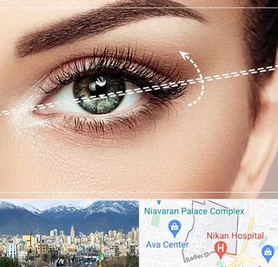 جراحی چشم گربه ای در آجودانیه 