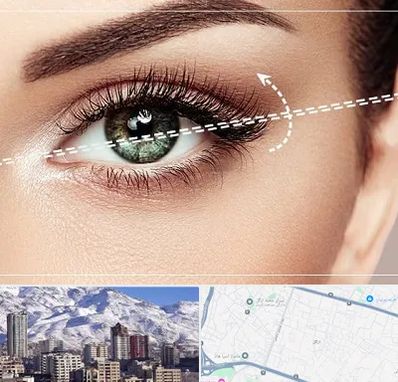 جراحی چشم گربه ای در ازگل