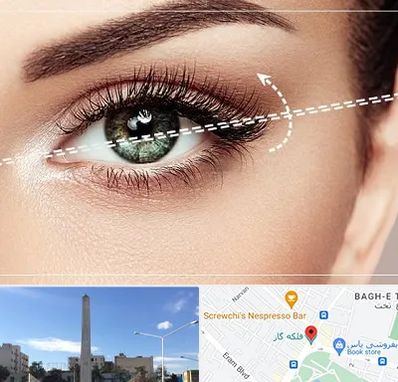 جراحی چشم گربه ای در فلکه گاز شیراز