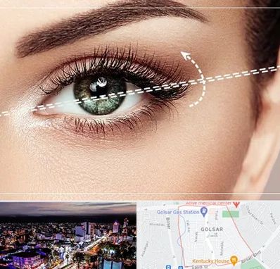 جراحی چشم گربه ای در گلسار رشت 