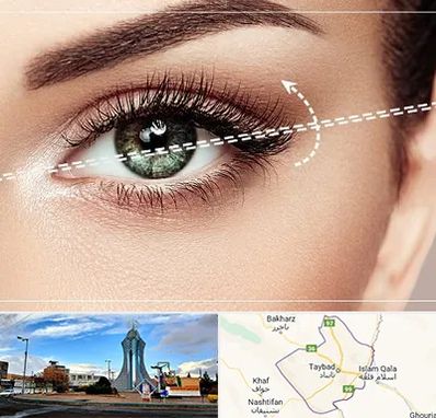 جراحی چشم گربه ای در تایباد