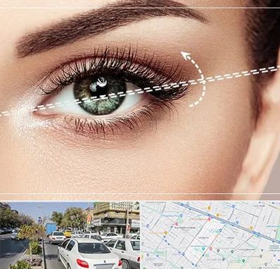 جراحی چشم گربه ای در مفتح مشهد