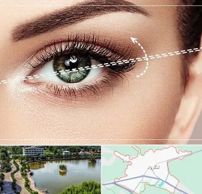 جراحی چشم گربه ای در لنگرود