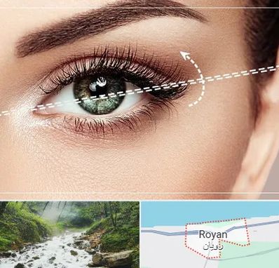جراحی چشم گربه ای در رویان
