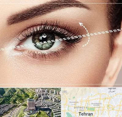 جراحی چشم گربه ای در شمال تهران 