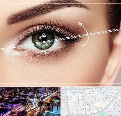 جراحی چشم گربه ای در منظریه رشت