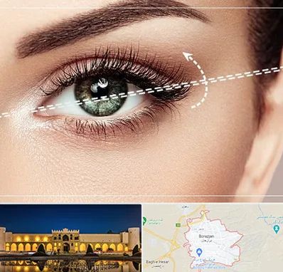 جراحی چشم گربه ای در برازجان