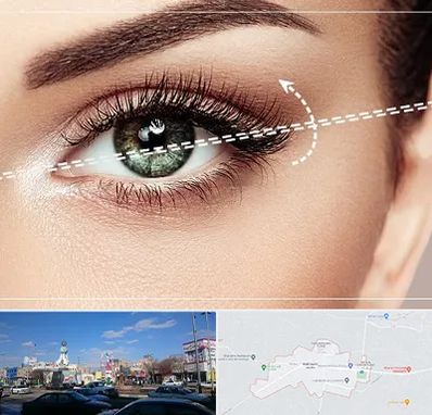 جراحی چشم گربه ای در ماهدشت کرج 