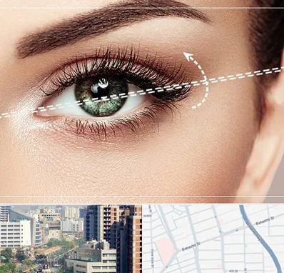 جراحی چشم گربه ای در خیابان بهشتی