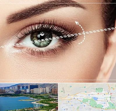 جراحی چشم گربه ای در منطقه 22 تهران 