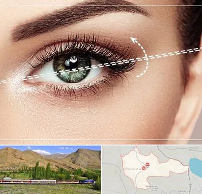 جراحی چشم گربه ای در خاش