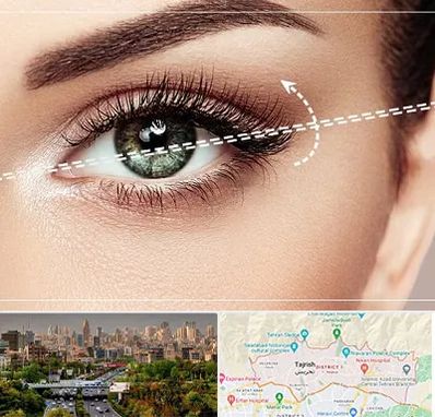 جراحی چشم گربه ای در منطقه 1 تهران 