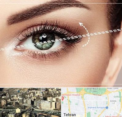 جراحی چشم گربه ای در مرزداران 