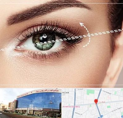 جراحی چشم گربه ای در نصف راه تبریز