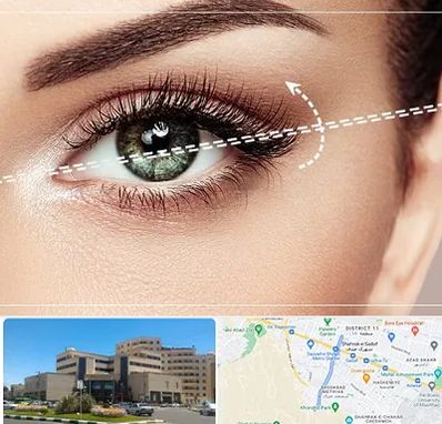 جراحی چشم گربه ای در صیاد شیرازی مشهد