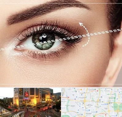 جراحی چشم گربه ای در جنت آباد تهران 