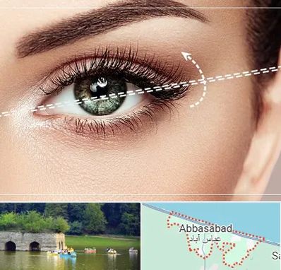 جراحی چشم گربه ای در عباس آباد