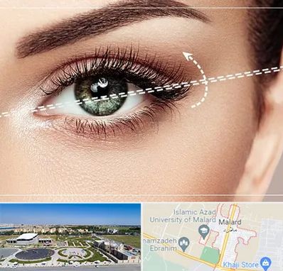 جراحی چشم گربه ای در ملارد