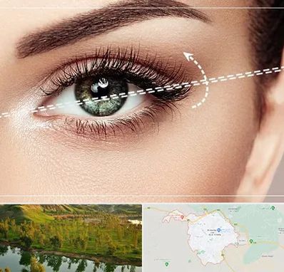 جراحی چشم گربه ای در بهبهان