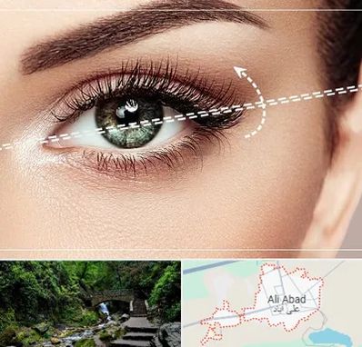 جراحی چشم گربه ای در علی آباد کتول