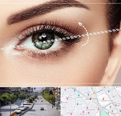 جراحی چشم گربه ای در خیابان زند شیراز