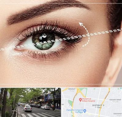 جراحی چشم گربه ای در ظفر 