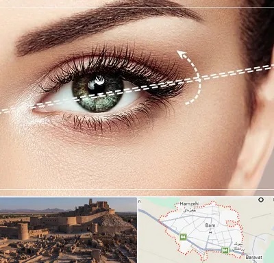 جراحی چشم گربه ای در بم