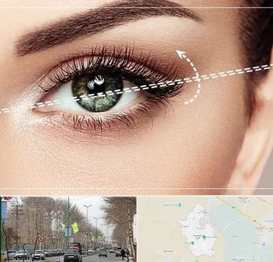 جراحی چشم گربه ای در نظرآباد کرج 