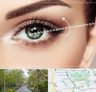 جراحی چشم گربه ای در قدوسی غربی شیراز