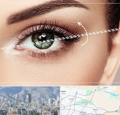 جراحی چشم گربه ای در شمال شرق تهران