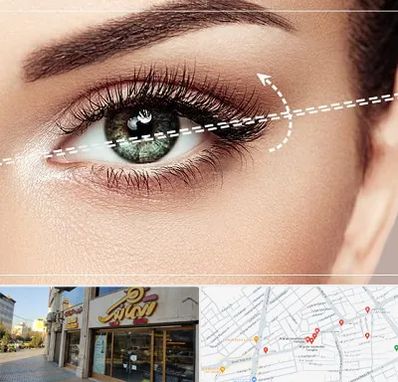 جراحی چشم گربه ای در عطاران قم