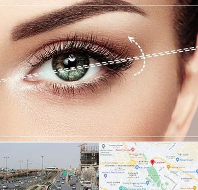 جراحی چشم گربه ای در بلوار توس مشهد 