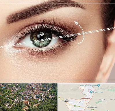 جراحی چشم گربه ای در دماوند