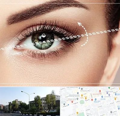 جراحی چشم گربه ای در میدان کاج 