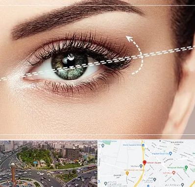 جراحی چشم گربه ای در سبلان 