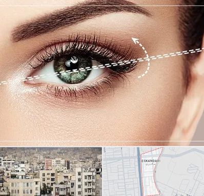 جراحی چشم گربه ای در اسکندری